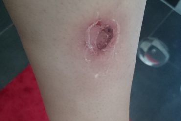 Infected Mosquito Bite